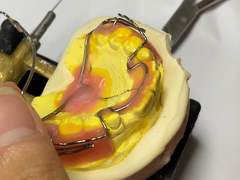 อุปกรณ์คัดเลือกสําหรับการรักษาฟัน