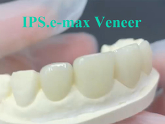 EMAX Veneer แนวคิดทางออกสําหรับการฟื้นฟูฟันที่ทนทานและสวยงาม