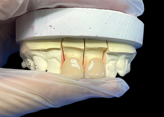 ซื้อ ความแรงแม่นยํา EMAX Porcelain Veneer ตัดสําหรับการฟื้นฟูความสวยงามที่ดูธรรมชาติ online manufacture