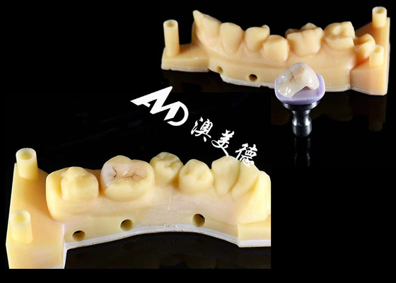 ซื้อ เนียน Hypoallergenic เซรามิก Inlays Onlays ปรับแต่งตามความต้องการ ทนทานคราบ ความทนทานสูง online manufacture