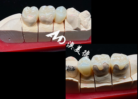 ซื้อ OEM Precision Fit Ceramic Inlays Onlays สําหรับการฟื้นฟูฟันที่ทนทานและมีลักษณะธรรมชาติที่มีความแข็งแรงและความน่าเชื่อถือสูงกว่า online manufacture