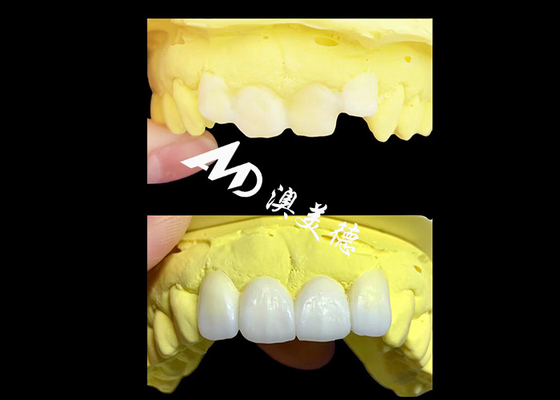 ซื้อ ราชกุฎฟันสีซิกโคนยาใสตามสั่ง ผลิตโดย AMD Dental Lab online manufacture