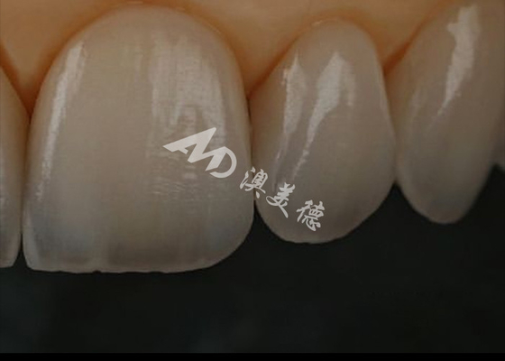 ซื้อ ความต้านทานต่อการฉีกซิกโคเนีย สีฟันสําหรับฟันด้านหน้า / ฟันด้านหลัง online manufacture
