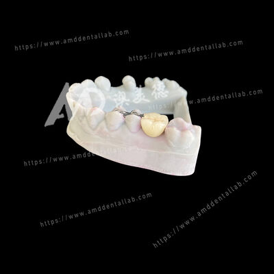 ซื้อ PFM สะพานฟันแบบแมรี่แลนด์ หนึ่งฟันปลอม สองปีก: ทางเลือกที่อนุรักษ์และสวยงาม online manufacture