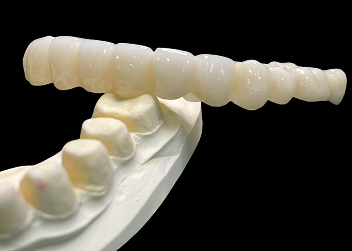 Vita Classical Shade All Ceramic Crown Bridge สีธรรมชาติ กําลังมองหาการฟื้นฟูฟัน