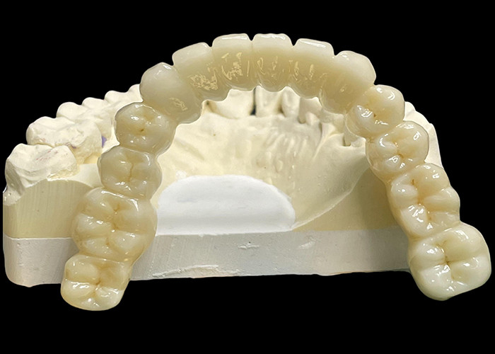 Vita Classical Shade All Ceramic Crown Bridge สีธรรมชาติ กําลังมองหาการฟื้นฟูฟัน