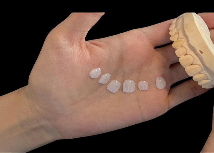 โปรเซลีนสี Ultra Thin EMAX Veneers กันคราบสําหรับการฟื้นฟูความงาม
