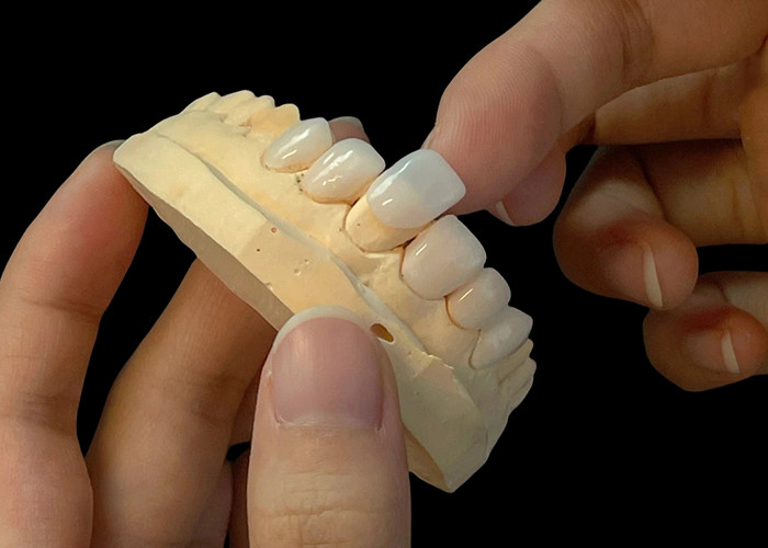 โปรเซลีนสี Ultra Thin EMAX Veneers กันคราบสําหรับการฟื้นฟูความงาม
