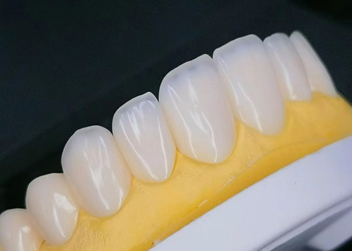 EMAX Porcelain Veneer with Stain Resistance สําหรับการฟื้นฟูความสวยงามที่ดูเป็นธรรมชาติ