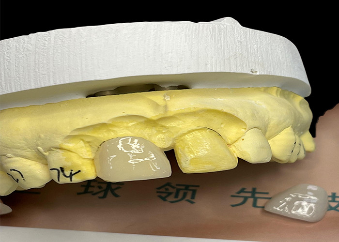 EMAX Porcelain Veneer with Stain Resistance สําหรับการฟื้นฟูความสวยงามที่ดูเป็นธรรมชาติ