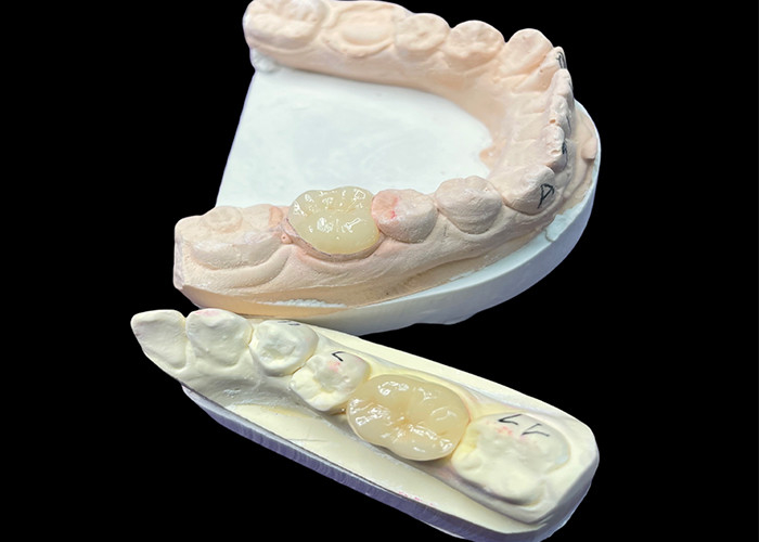 IPS e.max เครื่องประกอบและเครื่องประกอบเซรามิกสําหรับการฟื้นฟูฟันฟันฟัน