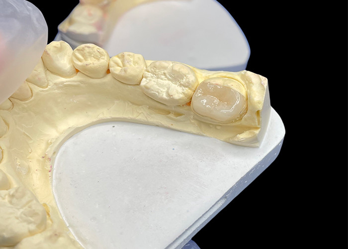IPS e.max เครื่องประกอบและเครื่องประกอบเซรามิกสําหรับการฟื้นฟูฟันฟันฟัน