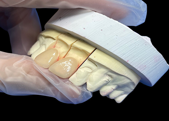 ความแรงแม่นยํา EMAX Porcelain Veneer ตัดสําหรับการฟื้นฟูความสวยงามที่ดูธรรมชาติ