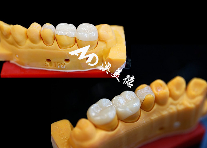 OEM Precision Fit Ceramic Inlays Onlays สําหรับการฟื้นฟูฟันที่ทนทานและมีลักษณะธรรมชาติที่มีความแข็งแรงและความน่าเชื่อถือสูงกว่า