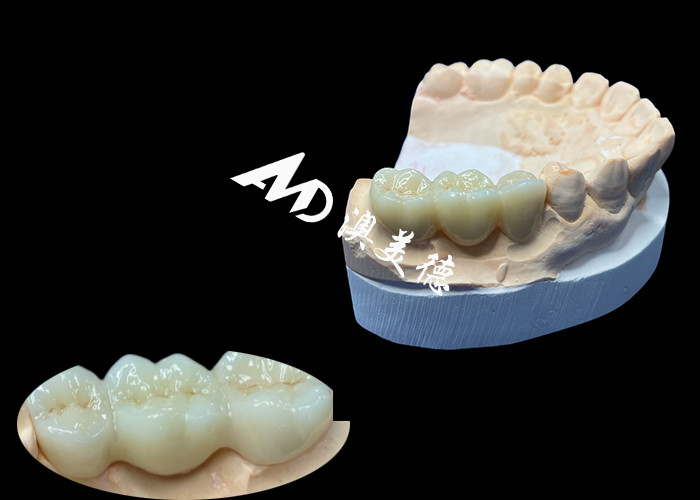 สีธรรมชาติ Zirconia รางวัลฟันทนทานกับรอยแตก สําหรับรอยยิ้มที่บริสุทธิ์จากห้องปฏิบัติการฟันจีน