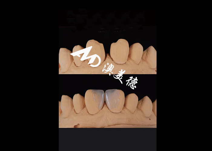 0.3-0.5 มิลลิเมตร อัลตราบาง IPS EMAX Porcelain Veneers สําหรับการแต่งหน้ายิ้มสวยงาม