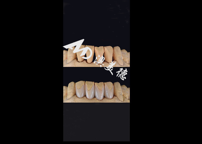0.3-0.5 มิลลิเมตร อัลตราบาง IPS EMAX Porcelain Veneers สําหรับการแต่งหน้ายิ้มสวยงาม