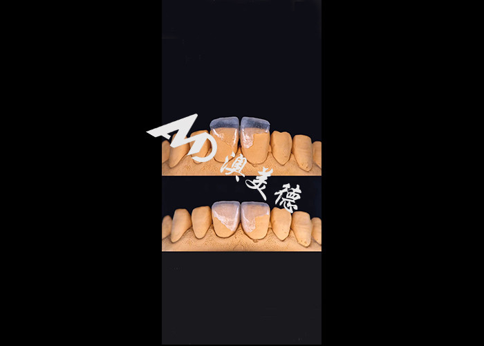 0.3-0.5 มิลลิเมตร อัลตราบาง IPS EMAX Porcelain Veneers สําหรับการแต่งหน้ายิ้มสวยงาม