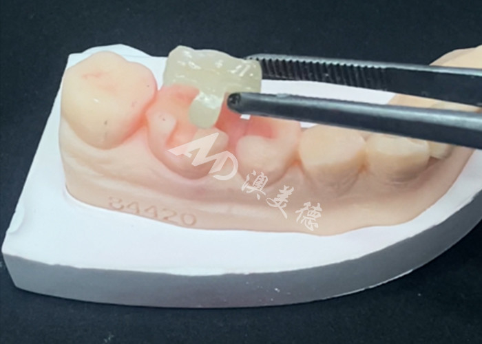 Emax Ceramic Inlays Onlays การฟื้นฟูฟันเพื่อสีฟันธรรมชาติและการบํารุงรักษาง่าย