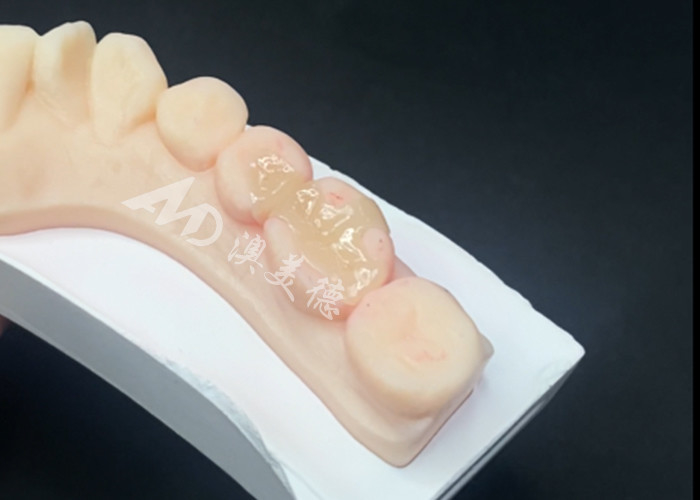 Emax Ceramic Inlays Onlays การฟื้นฟูฟันเพื่อสีฟันธรรมชาติและการบํารุงรักษาง่าย