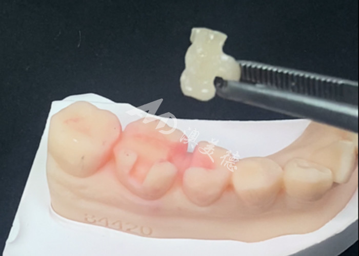 Emax Ceramic Inlays Onlays การฟื้นฟูฟันเพื่อสีฟันธรรมชาติและการบํารุงรักษาง่าย