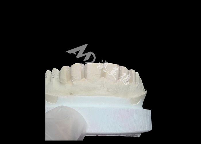 IPS Emax Veneers Prep ขั้นต่ํา / No-prep Veneers เป็นทางแก้ไขที่นวัตกรรมสําหรับรอยยิ้มสวยงาม