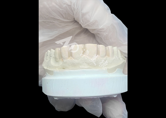 IPS Emax Veneers Prep ขั้นต่ํา / No-prep Veneers เป็นทางแก้ไขที่นวัตกรรมสําหรับรอยยิ้มสวยงาม