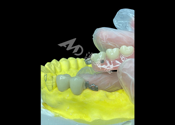 การผสมผสานฟันที่สามารถถอดออกได้แบบบุคคลบุคคลแบบ PFM + The Ultimate Solution for Comfort and Aesthetics