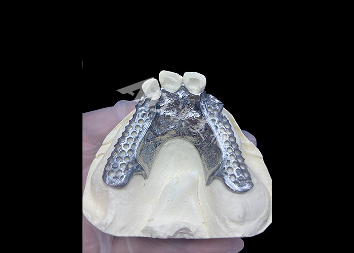 สะดวกสบาย Custom Cast Partial Denture โครงสร้างที่มั่นคงและดูธรรมชาติสําหรับผลการผลิตอย่างรวดเร็ว