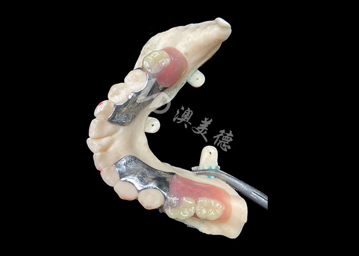 ปรับปรุงฟันเทียมส่วนละเอียดโครงสร้างโลหะแม่นยําสําหรับความเหมาะสมและการทํางานที่ดีที่สุด