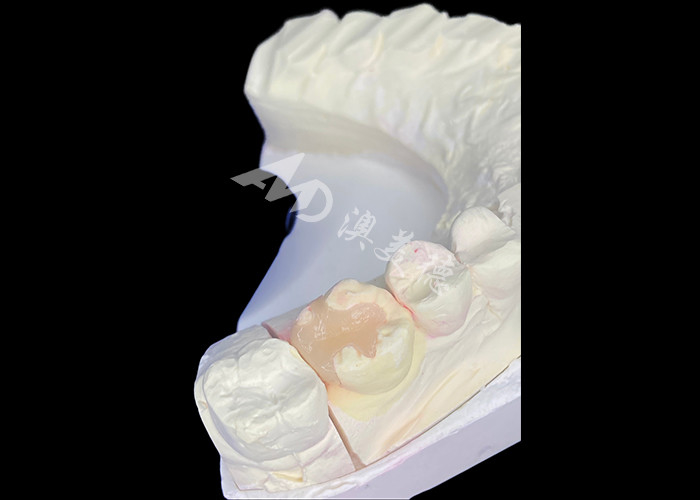 IPS e.max เครื่องประกอบและ เครื่องประกอบสําหรับการฟื้นฟูขนของขนที่มีผลการมองเห็นที่สวยงามและธรรมชาติที่ยั่งยืน