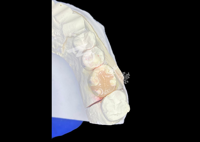 IPS e.max เครื่องประกอบและ เครื่องประกอบสําหรับการฟื้นฟูขนของขนที่มีผลการมองเห็นที่สวยงามและธรรมชาติที่ยั่งยืน