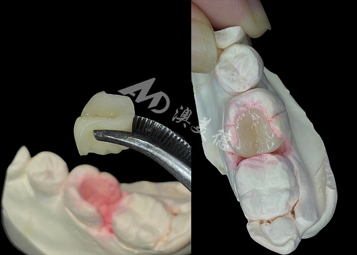 IPS e.max เครื่องประกอบและ เครื่องประกอบสําหรับการฟื้นฟูฟันฟันที่มีลักษณะธรรมชาติ