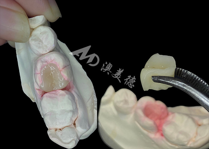IPS e.max เครื่องประกอบและ เครื่องประกอบสําหรับการฟื้นฟูฟันฟันที่มีลักษณะธรรมชาติ