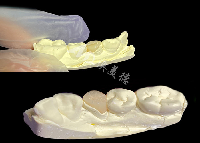 IPS e.max เครื่องประกอบและ เครื่องประกอบสําหรับการฟื้นฟูฟันฟันที่มีลักษณะธรรมชาติ