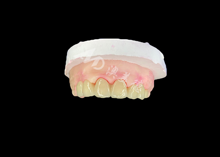 Wieland Zenostar Ceramic Crown Bridge ความละเอียดสูงสําหรับการฟื้นฟูที่ทนทานและดูธรรมชาติ