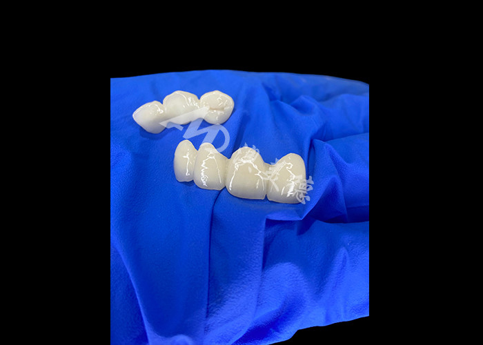 Wieland Zenostar Ceramic Crown Bridge ความละเอียดสูงสําหรับการฟื้นฟูที่ทนทานและดูธรรมชาติ