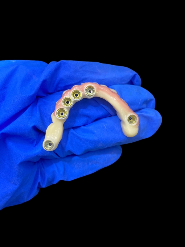 หมึกไทเทเนียมและ Zirconia Crown Implant สนับสนุนฟันเทียม ความแม่นยํา เหมาะสําหรับการสวมใส่ที่สบาย