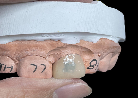ราคาดี EMAX Veneers เปลี่ยนแปลงรอยยิ้มของคุณ ด้วยฟันที่มองเป็นธรรมชาติ ออนไลน์