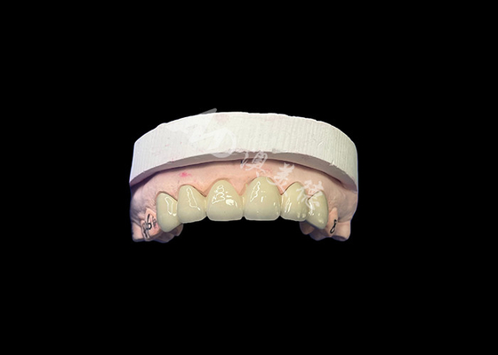 ราคาดี โปรเซลีนที่เข้ากันได้ด้วยชีวภาพหลอมเข้ากับมงกุฎโลหะ ความทนทานสูงเพื่อการฟื้นฟูที่ดีขึ้น ออนไลน์