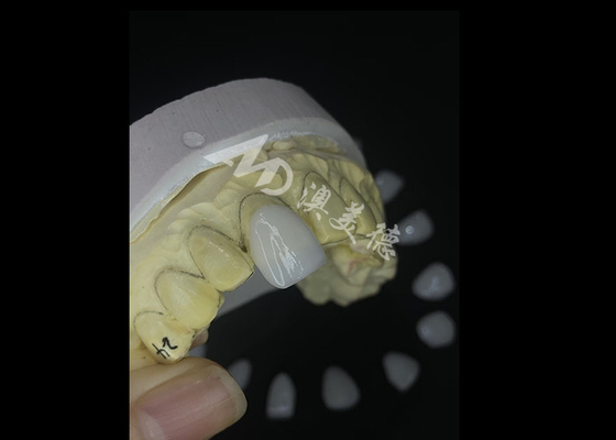 ราคาดี IPS e.max Veneers ที่ผลิตด้วยความแม่นยํา สําหรับการแปลงรอยยิ้มที่ไม่มีคู่แข่ง ออนไลน์