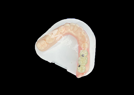 ราคาดี PFM สายกุหลาบฟัน แบบมีชีวิตและทนทานต่อการกัดกร่อน เพื่อสุขภาพปากที่ดีที่สุด ออนไลน์
